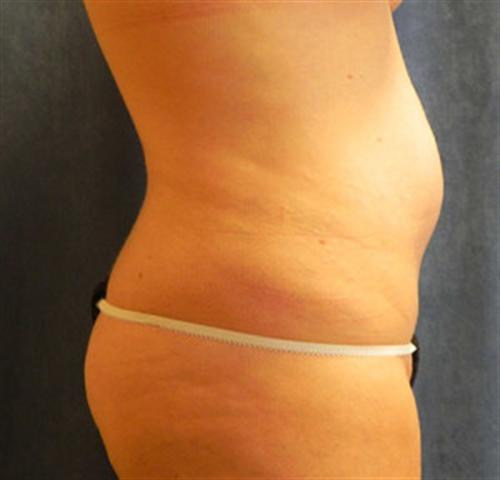 TUMMY TUCK CASE 386