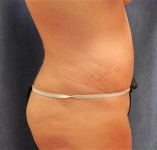 TUMMY TUCK CASE 386