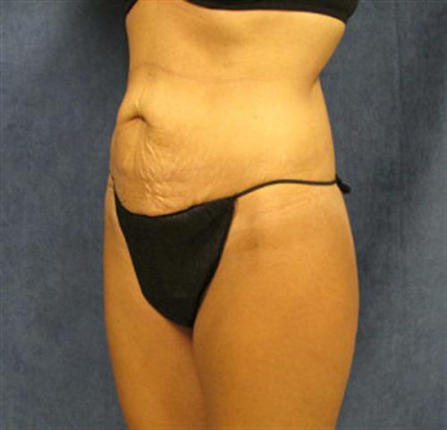 TUMMY TUCK CASE 387