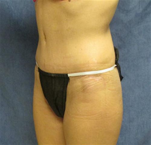 TUMMY TUCK CASE 387