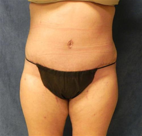 TUMMY TUCK CASE 388