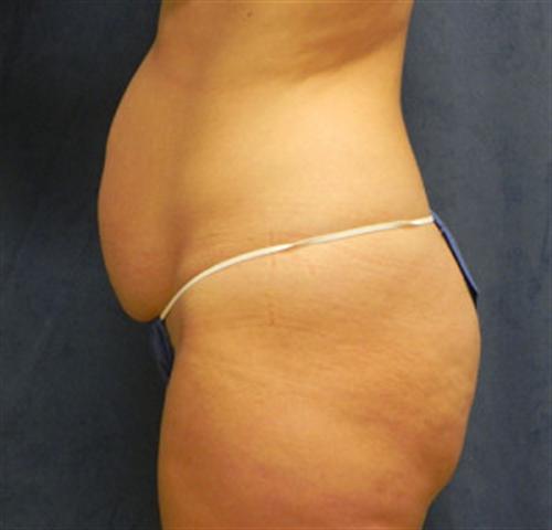 TUMMY TUCK CASE 389