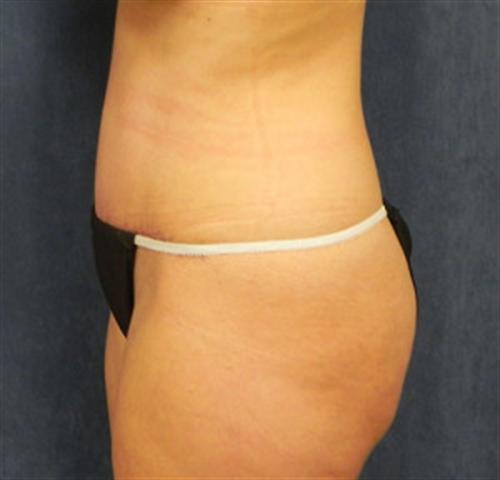 TUMMY TUCK CASE 389