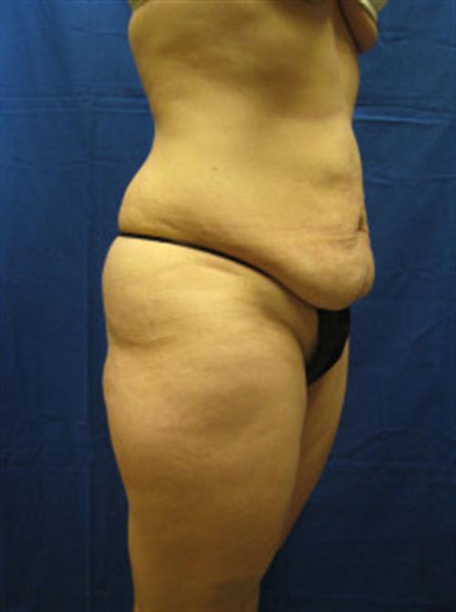 TUMMY TUCK CASE 390