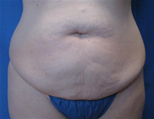 TUMMY TUCK CASE 391