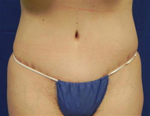 TUMMY TUCK CASE 391