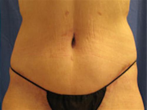 TUMMY TUCK CASE 392