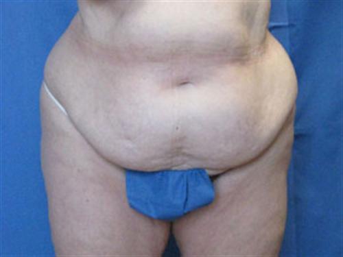 TUMMY TUCK CASE 393