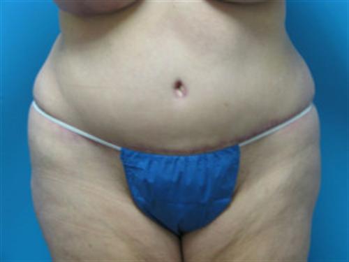 TUMMY TUCK CASE 393