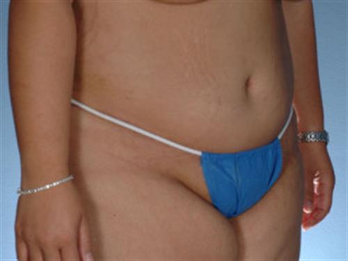 TUMMY TUCK CASE 394