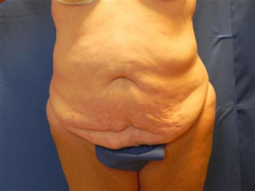 TUMMY TUCK CASE 395