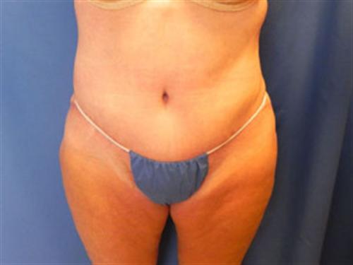 TUMMY TUCK CASE 395