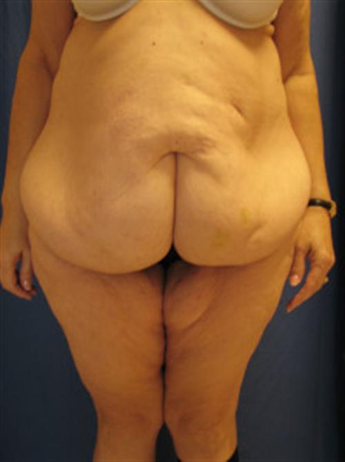 TUMMY TUCK CASE 396