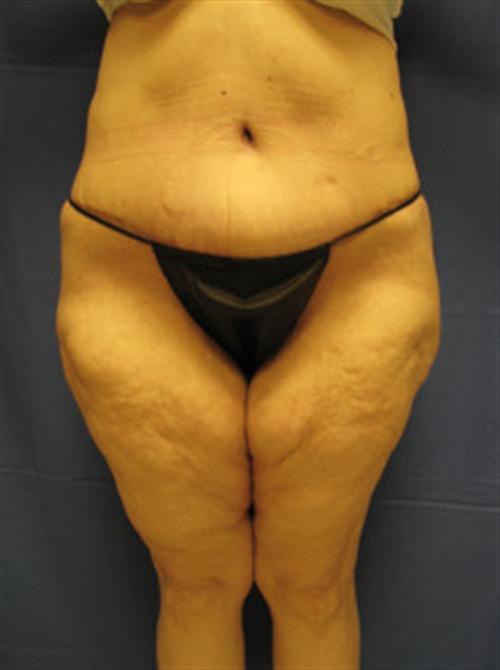 TUMMY TUCK CASE 396