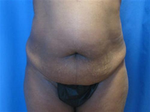 TUMMY TUCK CASE 397