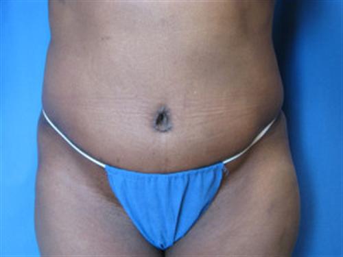 TUMMY TUCK CASE 397