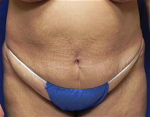 TUMMY TUCK CASE 398