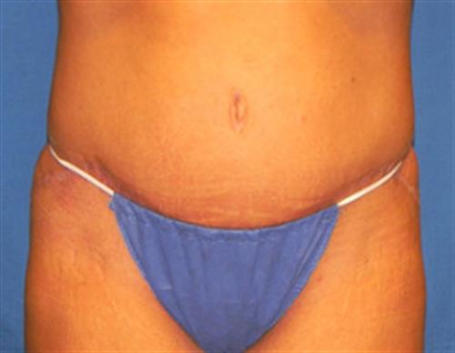 TUMMY TUCK CASE 398