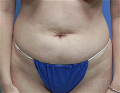 TUMMY TUCK CASE 399