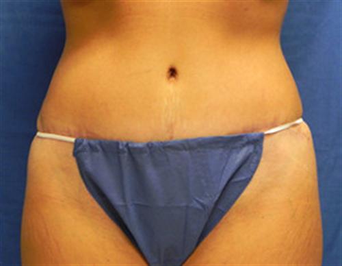 TUMMY TUCK CASE 399