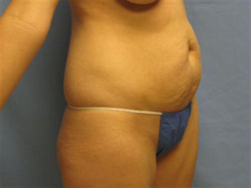 TUMMY TUCK CASE 400