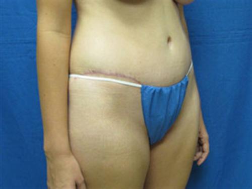 TUMMY TUCK CASE 400