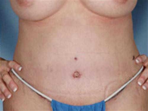 TUMMY TUCK CASE 401