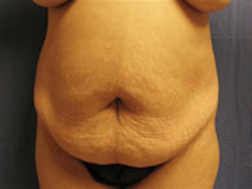 TUMMY TUCK CASE 402