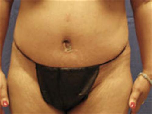 TUMMY TUCK CASE 402