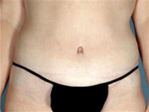 TUMMY TUCK CASE 404