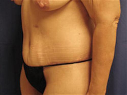 TUMMY TUCK CASE 405