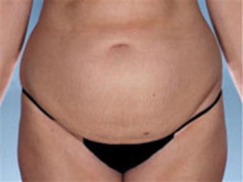 TUMMY TUCK CASE 406