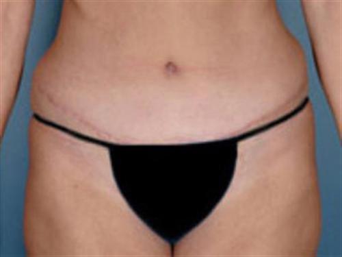 TUMMY TUCK CASE 406