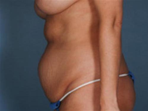 TUMMY TUCK CASE 407