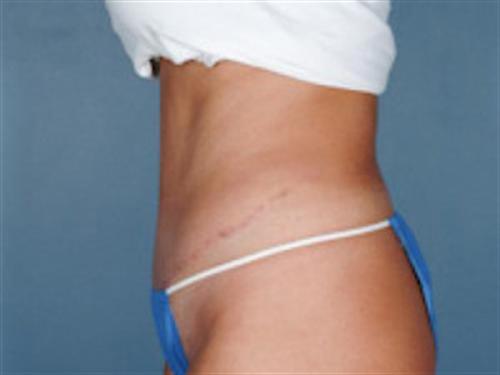 TUMMY TUCK CASE 407