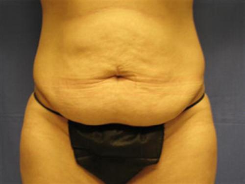 TUMMY TUCK CASE 408