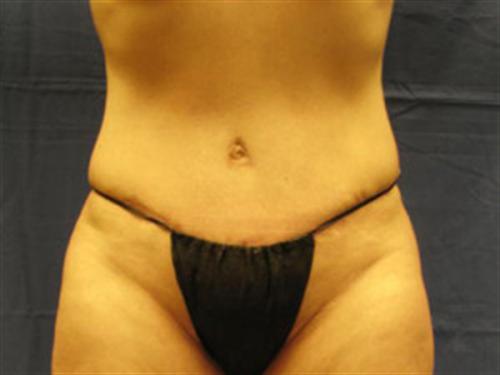 TUMMY TUCK CASE 408