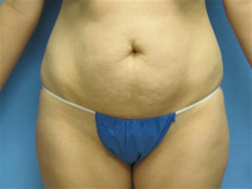 TUMMY TUCK CASE 409