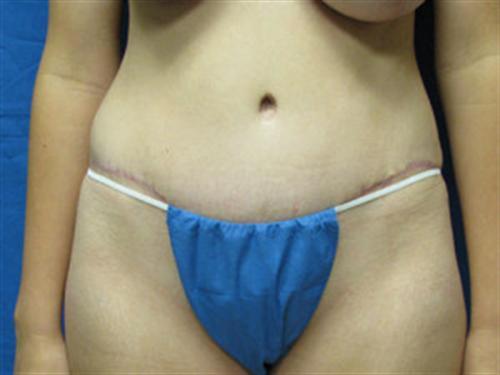 TUMMY TUCK CASE 409