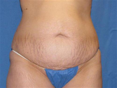 TUMMY TUCK CASE 410