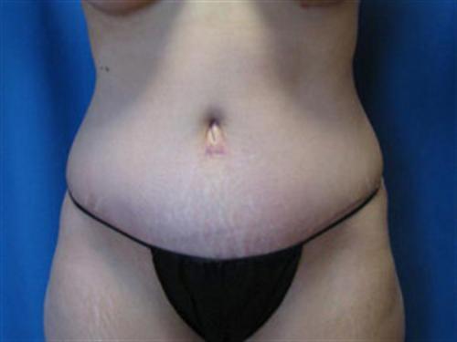 TUMMY TUCK CASE 410