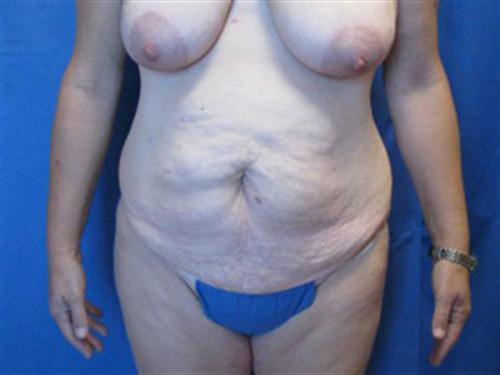 TUMMY TUCK CASE 411