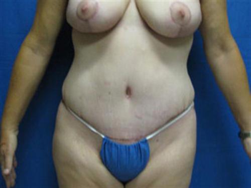 TUMMY TUCK CASE 411