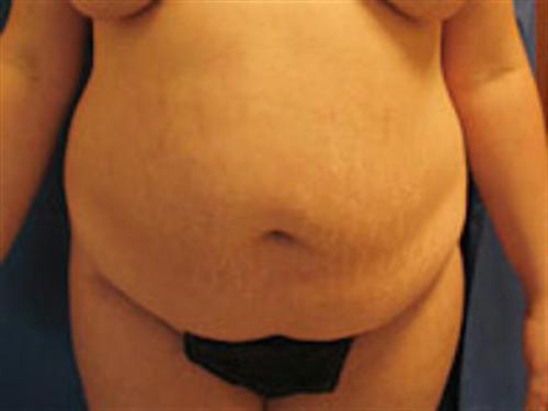 TUMMY TUCK CASE 412