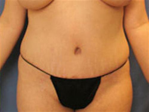 TUMMY TUCK CASE 412