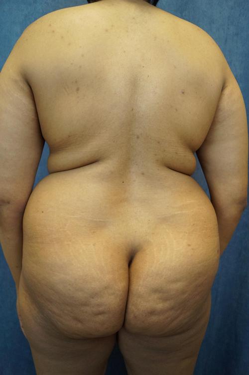 LIPOSUCTION CASE 421