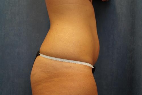 TUMMY TUCK CASE 423