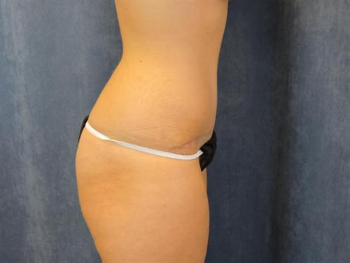 TUMMY TUCK CASE 423