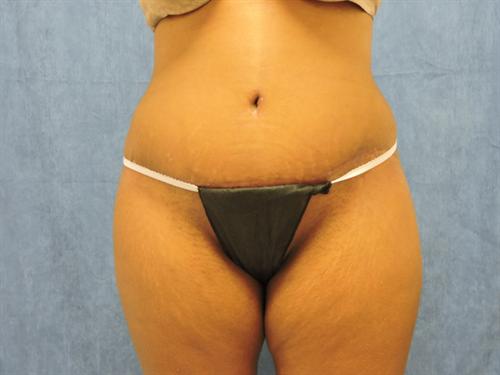 TUMMY TUCK CASE 424