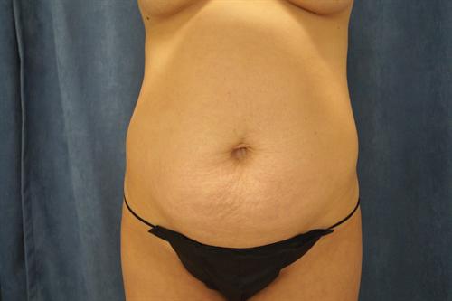 TUMMY TUCK CASE 442